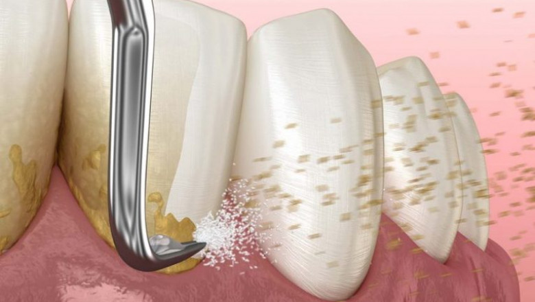 What Ask A Cosmetic Dentist Before Teeth Whitening?
