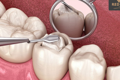 All You Need To Know in Taking Care Of Dental Fillings