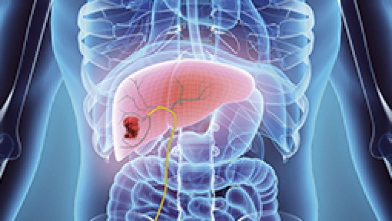 Best Hospital for liver cancer treatment in India