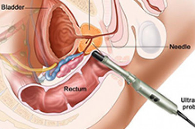 Prostate Cancer Hospitals in India