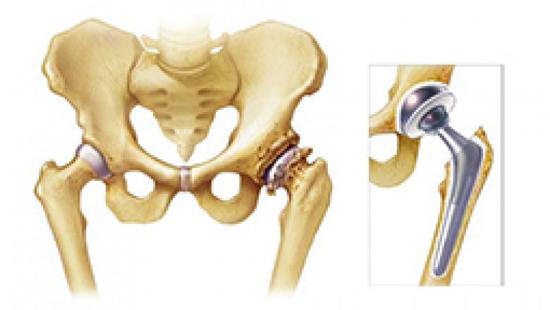 Hip replacement surgery in India