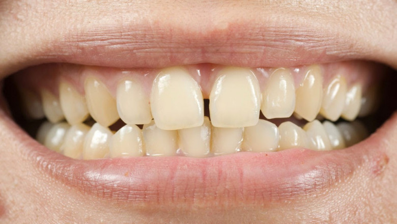General Dentists and Restorative Procedures