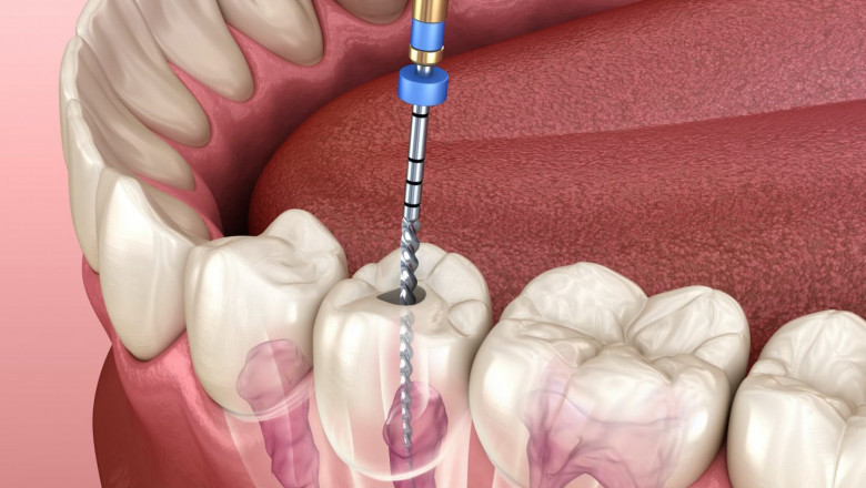 Root Canal