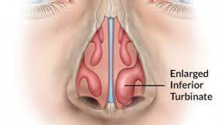 Diode Laser--One of the Effective and Economical treatment for ITH (Inferior Turbinate Hypertrophy)