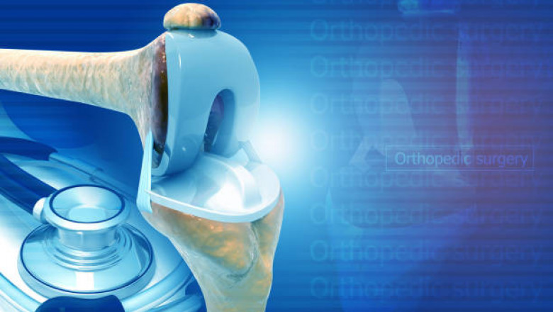 Medical Implants Market - Growth, Trends, COVID-19 Impact, and Forecasts 2027