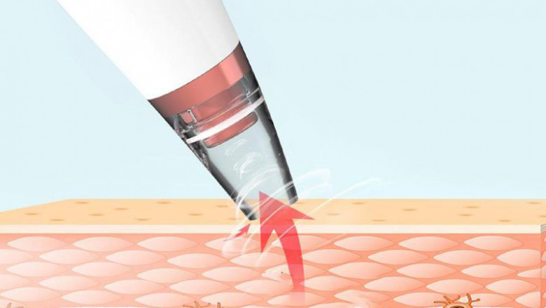 Electric Rechargeable Blackhead Remover – Get Rid Of The Blackheads