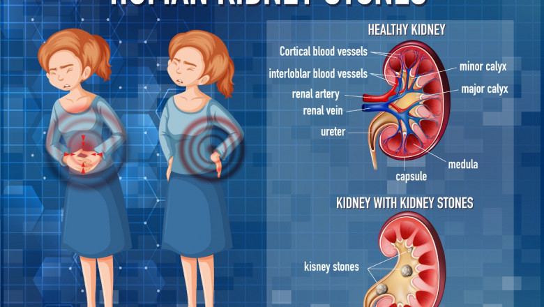 What Are The Locations Of Kidney Stones?