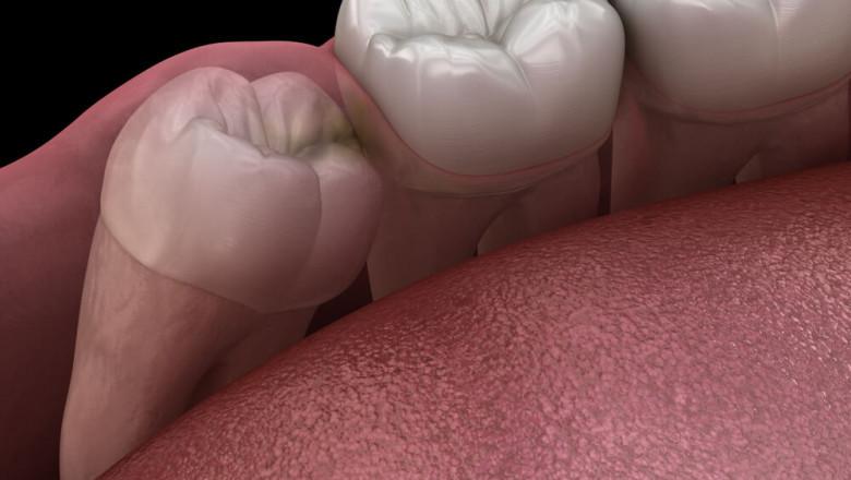 How Many Types Of Wisdom Teeth Extraction?