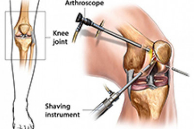 Arthroscopy Surgery in India