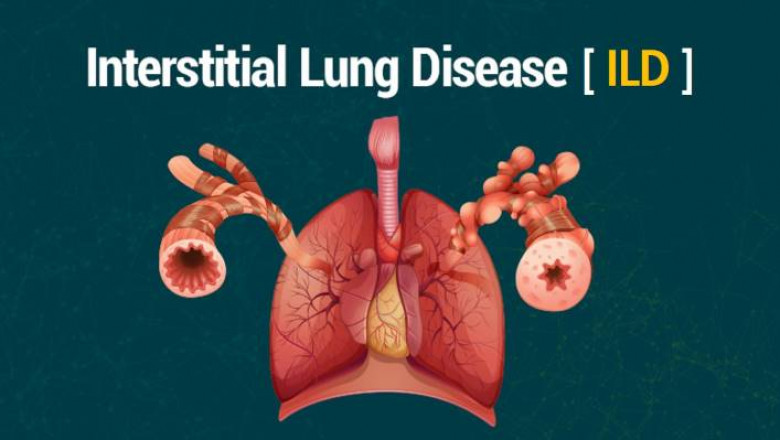 It Is A Condition In Which The Lung Tissues Can Gradually Scar As A Result Of A Disturbance In The Interstitial Lung Disease