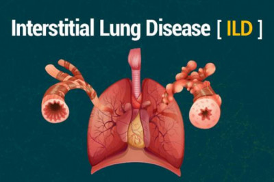 It Is A Condition In Which The Lung Tissues Can Gradually Scar As A Result Of A Disturbance In The Interstitial Lung Disease