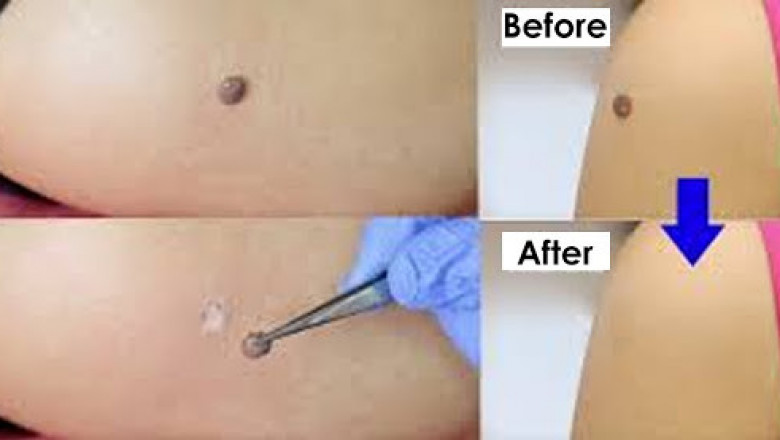 Hpv Warts Removal Treatment In Malaysia – Go To A Reputed Clinic