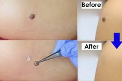 Hpv Warts Removal Treatment In Malaysia – Go To A Reputed Clinic