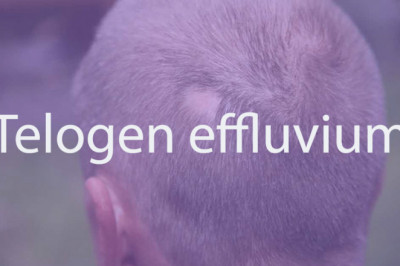 Telogen effluvium