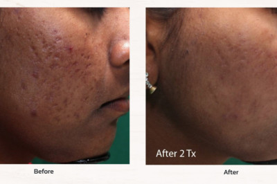 What To Count on From An Acne Treatment Clinic