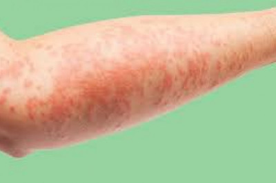 Global Atopic Eczema Treatment Market share and trends and forecast 2022-2027
