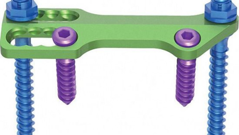 Global Spinal Thoracolumbar Implants Market Trends, Research, and Analysis for the Forecast 2022-2027