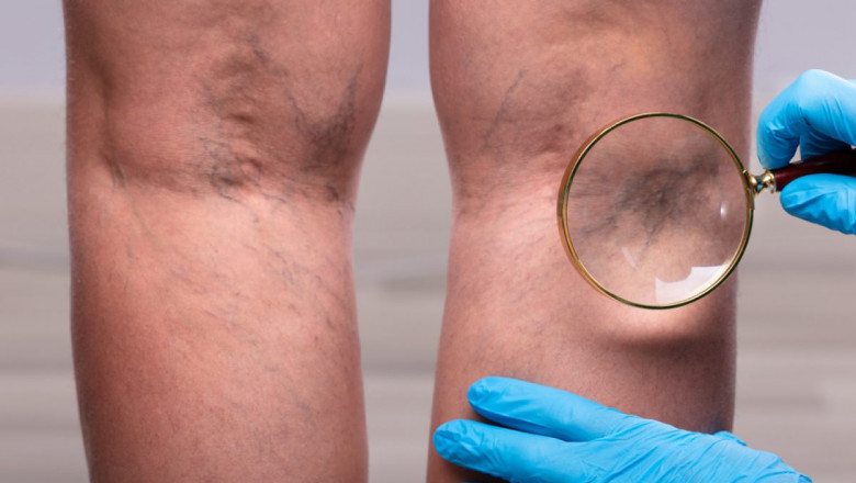 Is There A Way To Permanently Cure Varicose Or Spider Vein?