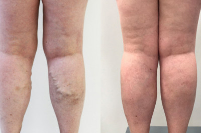 What Things You Should Know During Recovery Of EVLT?