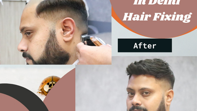 The best hair loss treatment for men- Delhi Hair Fixing