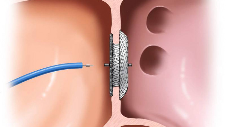 Device Closure Surgery in Pune | Dr. Kartik Bhosale