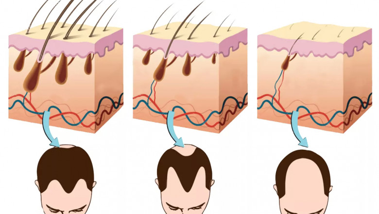 What All Could Be Causing Your Hair Loss? Read On To Learn More