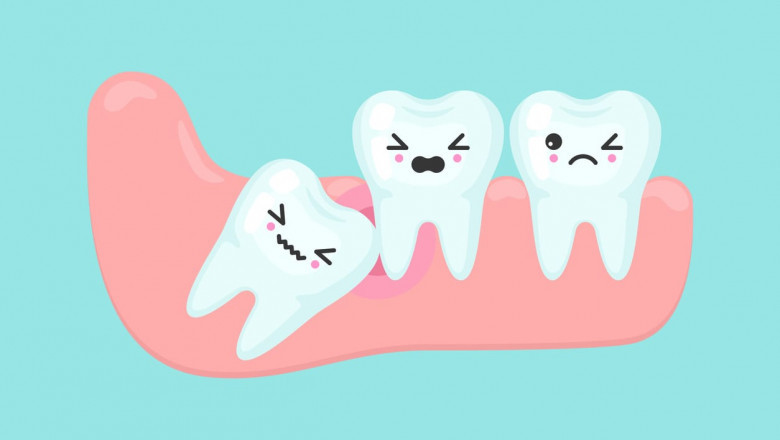 Can Bleeding Gums Be A Cause For Wisdom Teeth Removal?