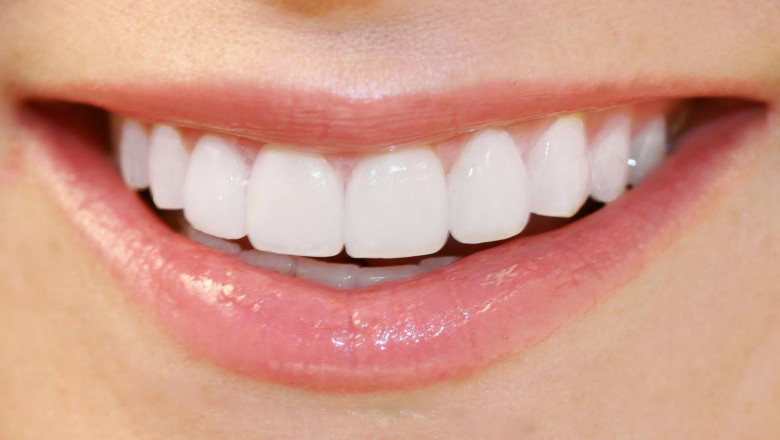 Is Professional Teeth Whitening Worth It?