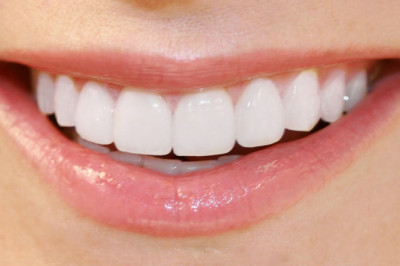 Is Professional Teeth Whitening Worth It?