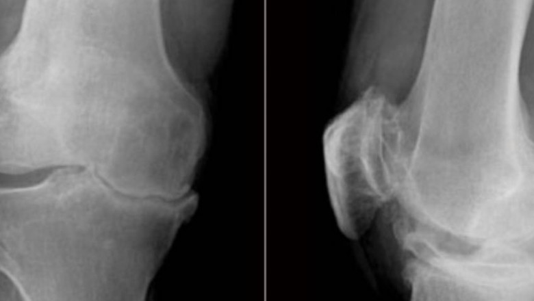 Osteoarthritis - Is it just a degenerative process? - Ortho Patna