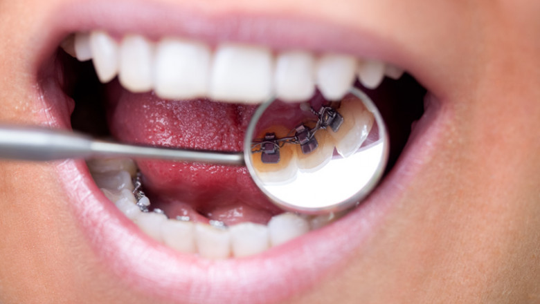 Veneers and Their Benefits - Tower House Dental Clinic