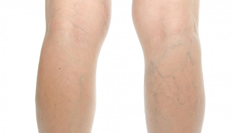What Are The Most Frequently Asked Questions About Ligation And Stripping Surgery?