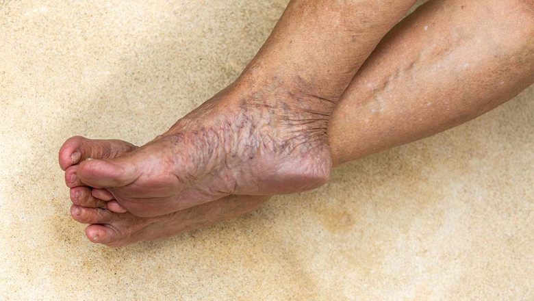 What Questions To Ask Your Varicose Vein Doctor?