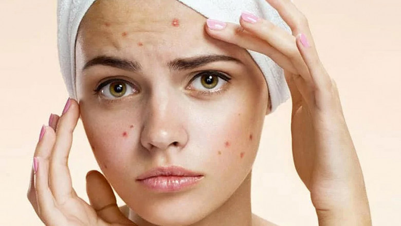 Global Acne Vulgaris Treatment Market: Size, Share, Growth, Opportunities And Forecast 2018-2026