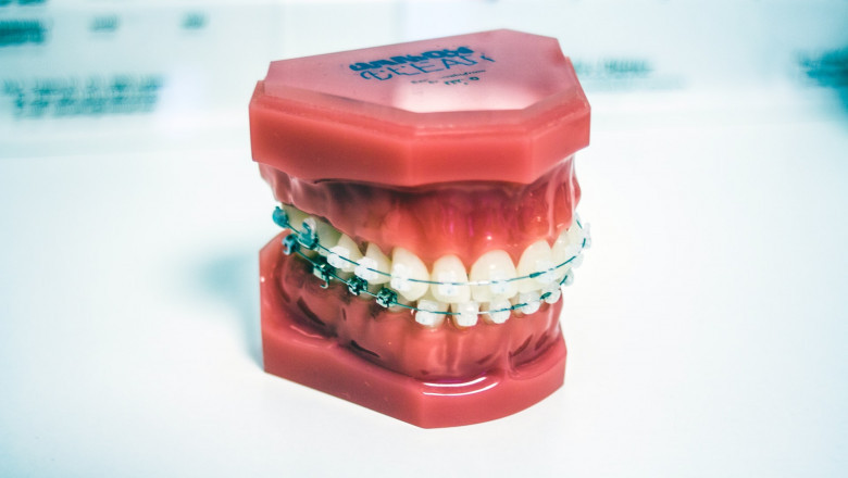 5 Pro's of Orthodontic Treatment