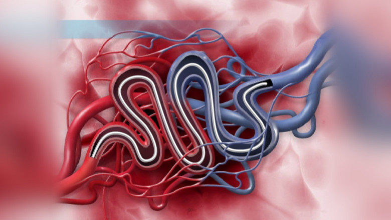 Embolization Market Restraints, Analysis and Forecast 2020-2027