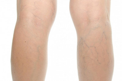 What Are Varicose Veins?