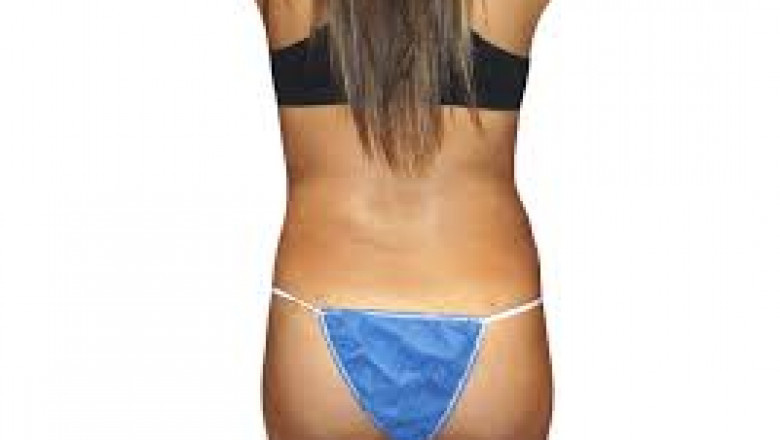 What Do You Need To Know About Liposuction?