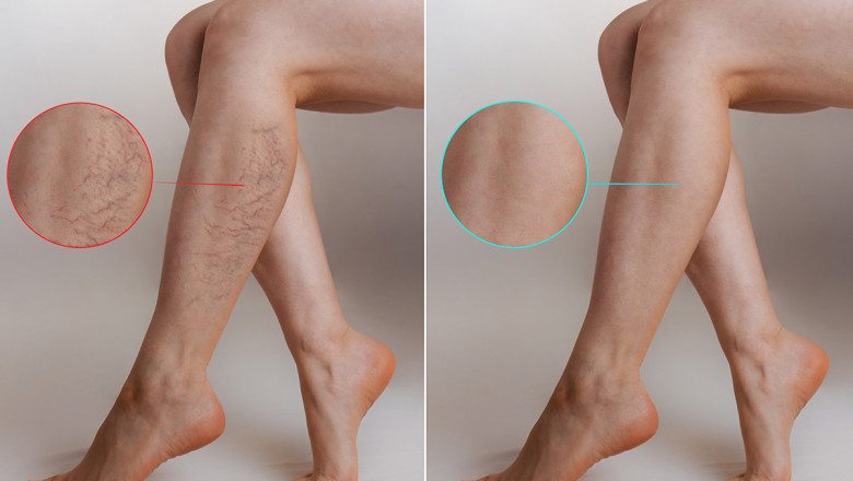 What Should We Watch Out For If You Have Varicose Veins?
