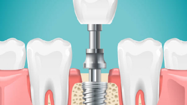 Do You need to Know About Dental Implants