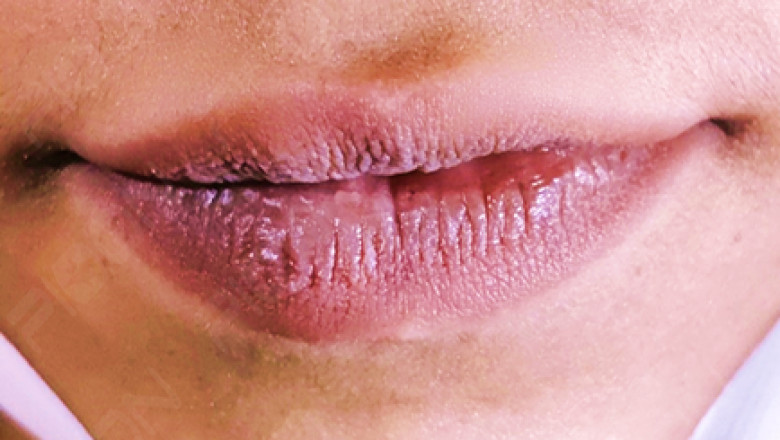 Lip Depigmentation with Laser