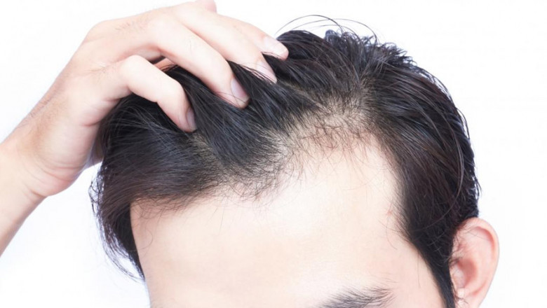 Illnesses that cause hair loss