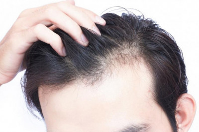 Illnesses that cause hair loss