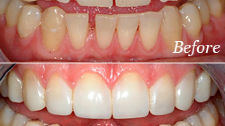 Care Dental Spa – We offer complete and satisfactory root canal treatment