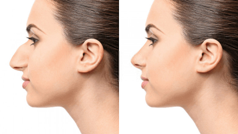 Is Nose Job Painful? Stages of Rhinoplasty Pain