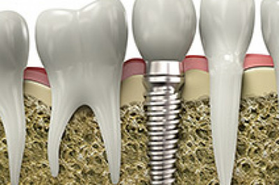 We offer world-class dental implant services.