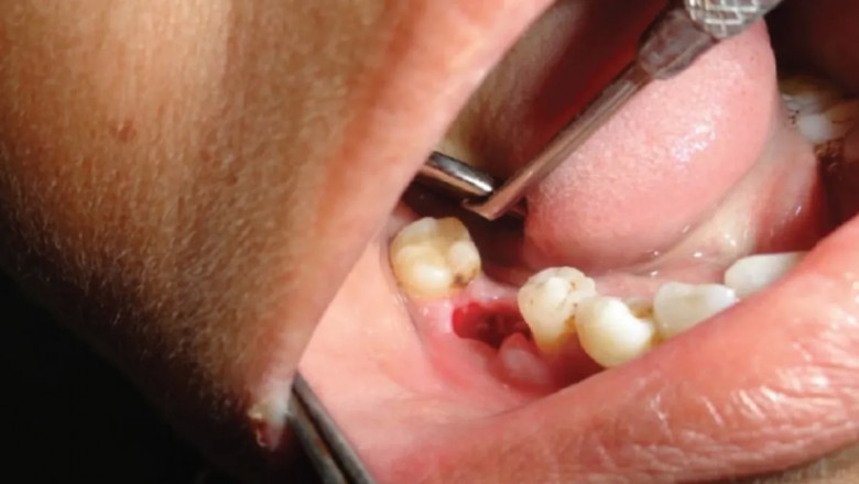 Dental Extraction Tips