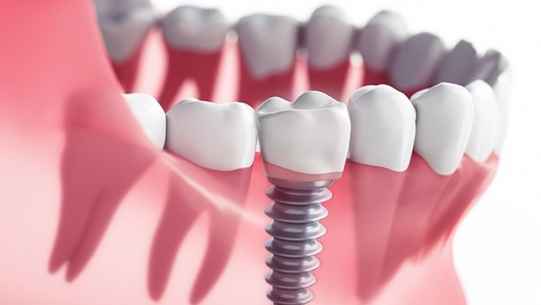 Dental Implants Pros