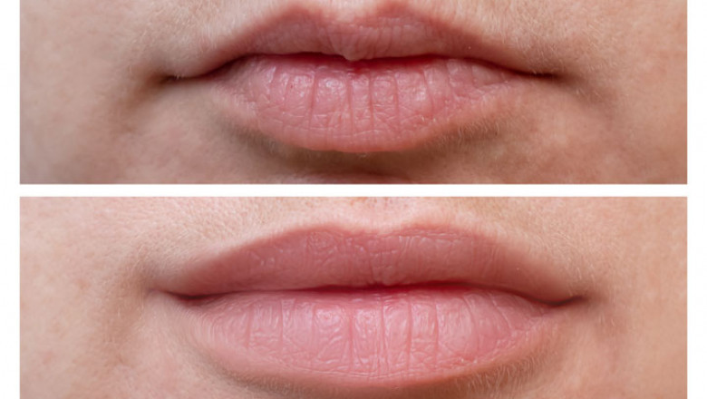 Types of Lip Enhancement Procedures