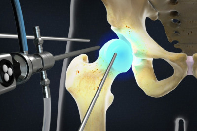Global Arthroscopy Devices Market Region